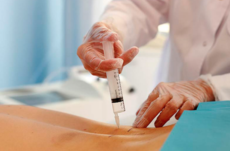 Ozonoterapia