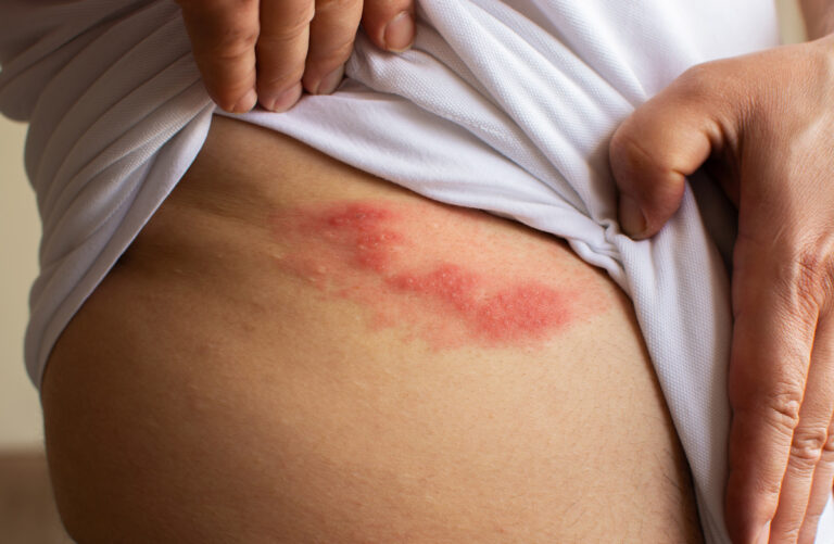Herpes Zoster