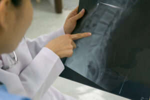 Fractura columna vertebral